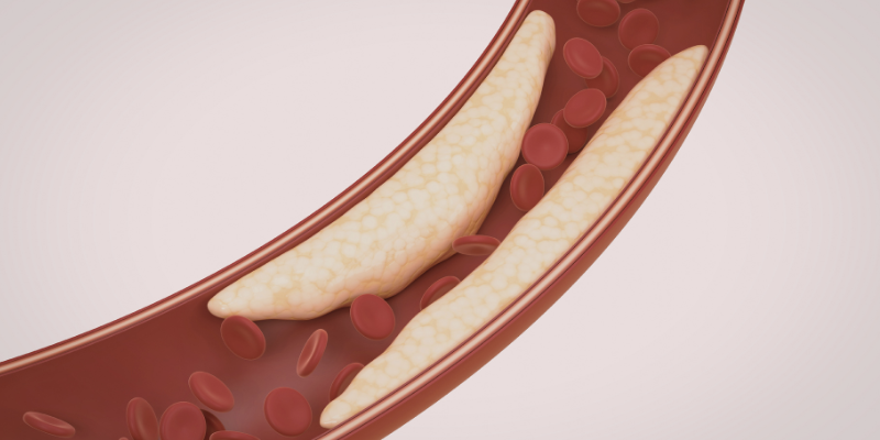 Plaque buildup in arteries.